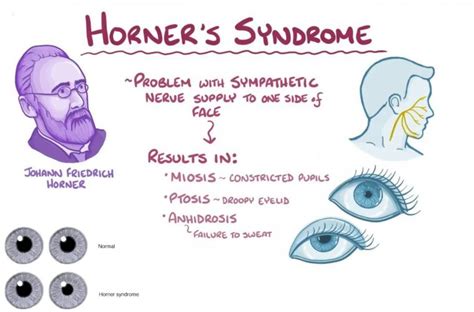 Horner'S Syndrome 2023