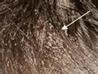 Hot Air for the Treatment of Head Lice? - Medscape