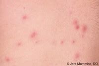 Hot Tub Folliculitis - American Osteopathic College of ... - AOCD