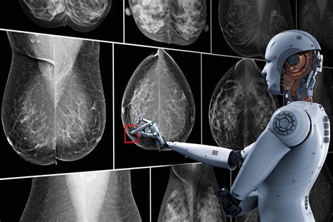 How AI is helping detect breast cancer