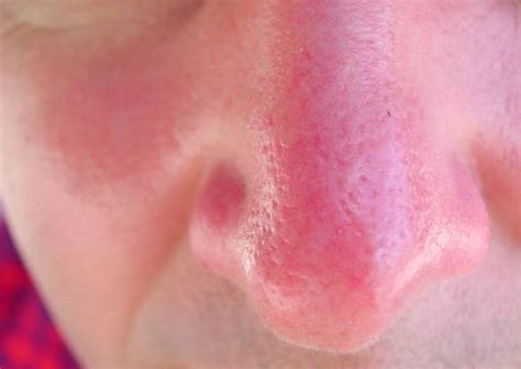 How Can You Protect Your Nose from Sunburn? - People