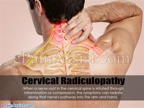 How Cervical Radiculopathy Causes Pain, …