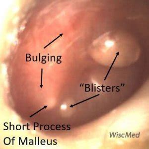 How Common Is Bullous Myringitis? Pediatric Case and Referen…