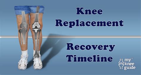 How Do I Know if My Knee Replacement Has Been Recalled?