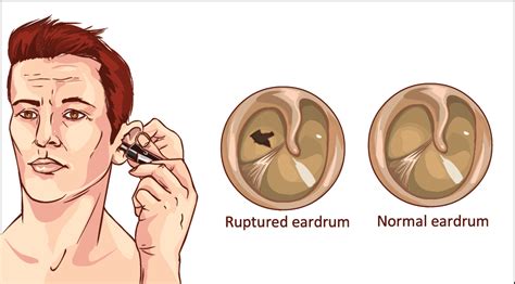 How Do You Know If You Ruptured Your Eardrum?