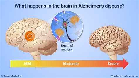 How Does Alzheimer’s Disease Affect Intelligence?