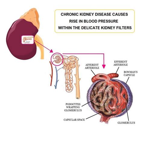 How Does Hypertension Affect The Kidneys - ﻿Immobilien Kolb