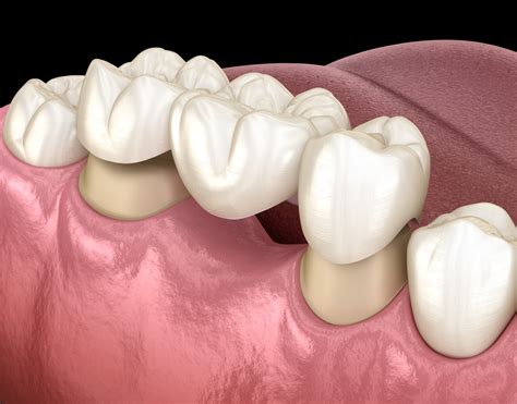 How Does a Dental Bridge Work? - designerforsmiles.com