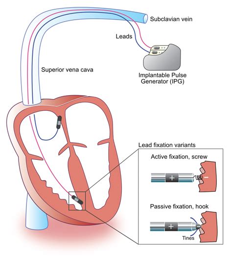 How Easy Is It To Dislodge Pacemaker Leads