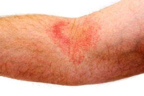 How Eczema Works HowStuffWorks