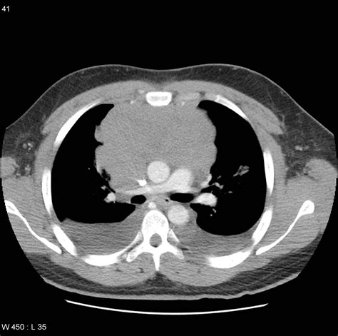 How I Diagnose Primary Mediastinal (Thymic) Large B-Cell Lymphoma.