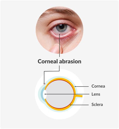 How Long Does It Take For A Scratched Cornea To Heal?