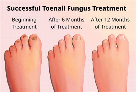 How Long Does It Take For Toenail Fungus To Go Away?