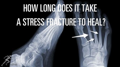 How Long Does It Take for a Metatarsal Fracture to Heal?