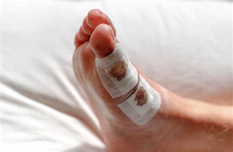 How Long Does Swelling Last After Bunion Surgery?