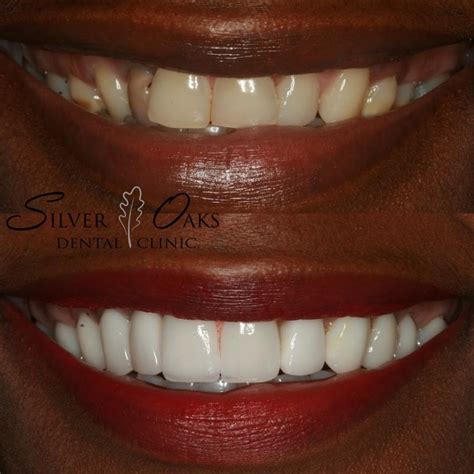 How Much Do Veneers Cost In South Africa? - South African Lists