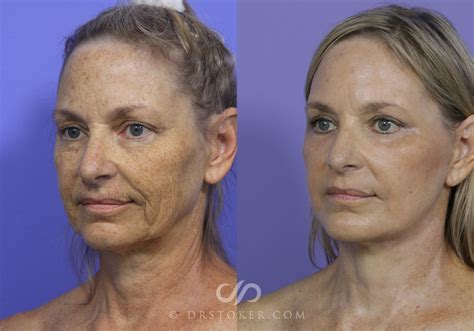 How Much Does A Facelift Cost In Dallas, Texas? - Dr. Liland