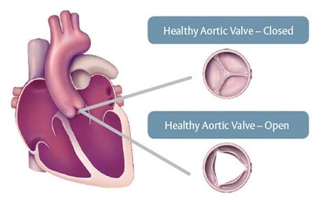 How Much Does Aortic Valve Replacement Surgery Cost?