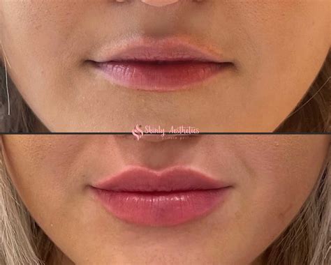 How Much Is 1 Ml Of Lip Filler - 666how.com