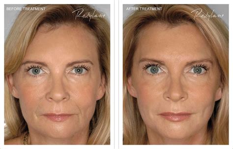 How Much Restylane Will You Need To Treat Under Eye Wrinkles?