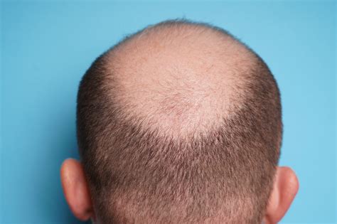 How Not to Go Bald