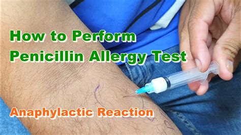 How Penicillin Allergy Testing is Done YouTube