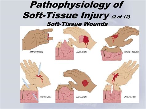 How Serious Are Soft Tissue Injuries? Integrated