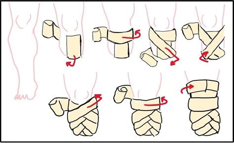 How To Bandage An A.K. Amputation Stump O&P Virtual Library