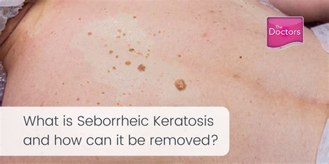 How To Cure Seborrheic Keratosis