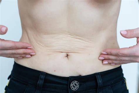 How To Differentiate Between Loose Skin vs. Fat: The Ultimate …