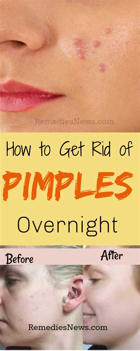 How To Get Rid Of Pimples Fast – Top 10 Effective Remedies