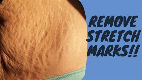 How To Get Rid Of Stretch Marks In A Week - 24 Info Channel