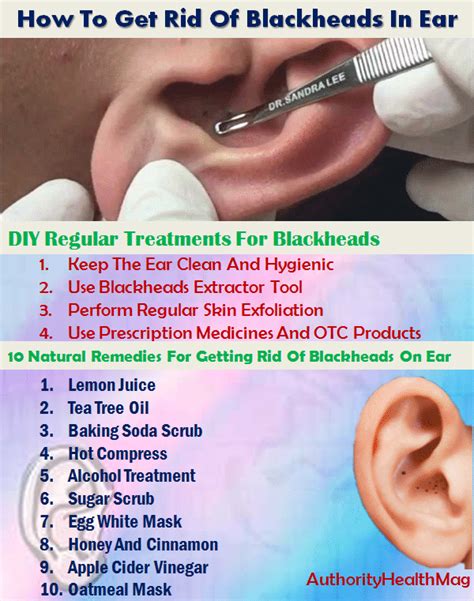 How To Get Rid of Blackheads In Your Ear - Parade