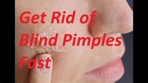 How To Get Rid of Blind Pimple How To Treat A Blind Pimple