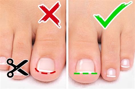 How To Get Toenails To Grow Straight Using Curve Correct