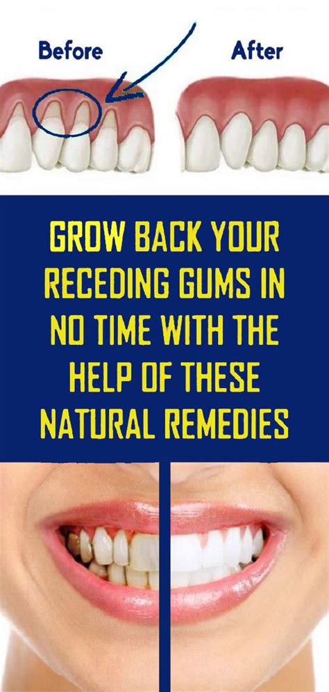 How To Help Receding Gums Grow Back? - Health Happiness