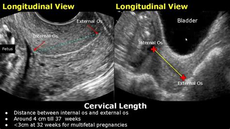How To Measure Cervical Length