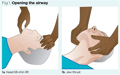 How To Open Airway With Head Injury? - Braintalk.quest