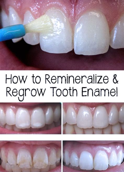 How To Remineralize Teeth Enamel How To Guide