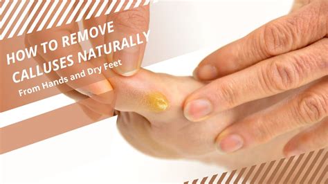 How To Remove Calluses From Feet And Fingers Naturally