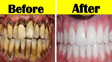 How To Remove Coffee Stains From Teeth With Braces - 3 Ways …