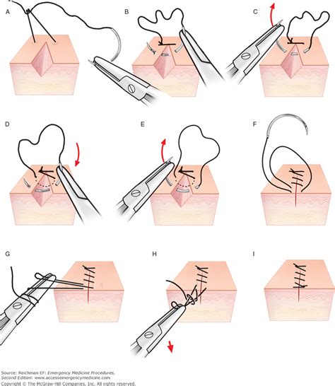 How To Repair a Laceration With a Subcuticular Running Suture