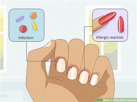 How To Stop Itching Cuticles - imaginail.com