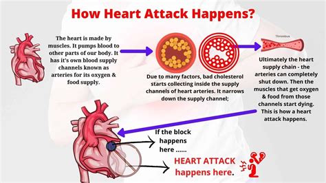 How a Heart Attack Occurs - HHMI BioInteractive