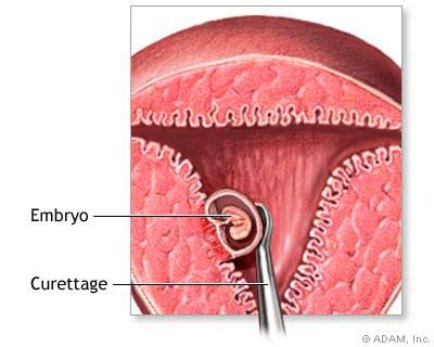How a late term abortion is performed