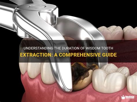 How a wisdom tooth is extracted