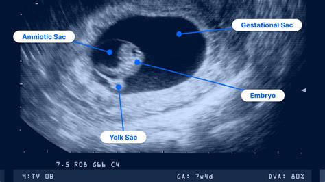 How accurate is an early ultrasound