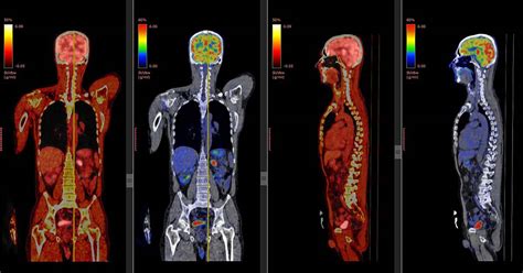 How accurate is pet scan