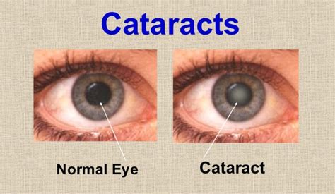 Cataracts may appear as cloudy, white areas in the middle region of a person’s eyes. A person may not know they have cataracts until their vision becomes blurry and less colorful. A cataract is .... 