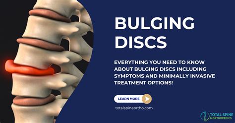 How bad is a bulging disc